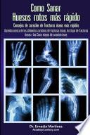 Libro Como curar huesos rotos más rápido. Consejos para curar fracturas de huesos: Aprenda sobre los alimentos para la curación de fracturas, los tipos de f